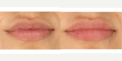 Lip Fillers before and after photo