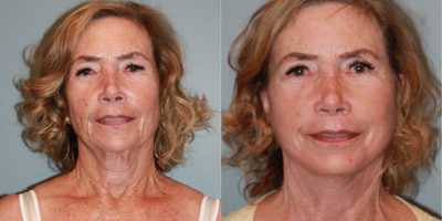 Lower Facelift before and after photo