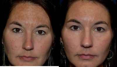 PicoSure before and after photo