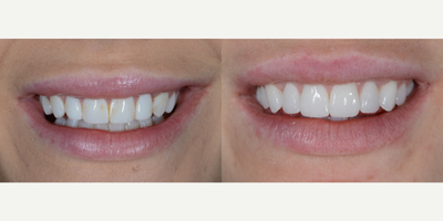 Porcelain Veneers before and after photo