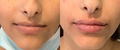 Restylane before and after photo
