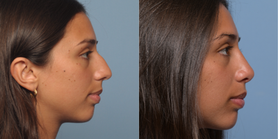Rhinoplasty before and after photo