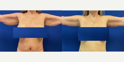 Arm Lift before and after photo