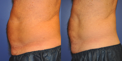 CoolSculpting before and after photo