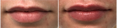 Dermal Fillers before and after photo