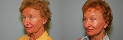 Facelift before and after photo