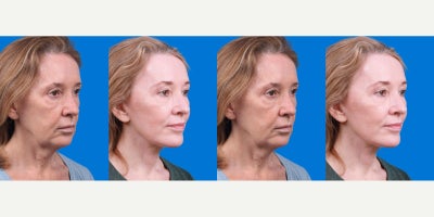 Facelift before and after photo