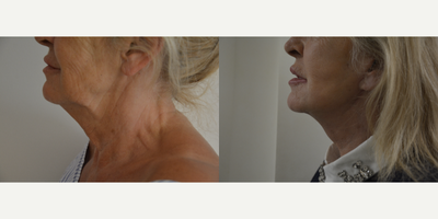 Neck Lift before and after photo