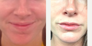 Restylane before and after photo
