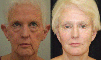 Lower Facelift before and after photo