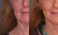 Lower Facelift before and after photo
