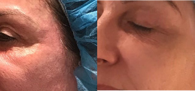 Microneedling before and after photo