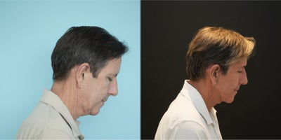 Deep Plane Facelift before and after photo