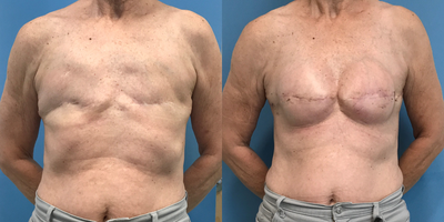 Breast Reconstruction before and after photo