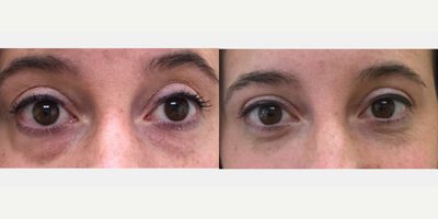 Dermal Fillers before and after photo