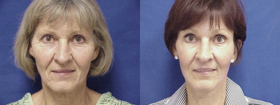 Facelift before and after photo