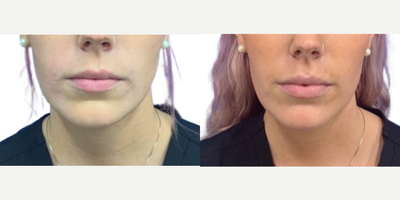 Lip Fillers before and after photo
