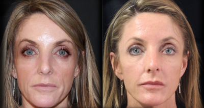 Liquid Facelift before and after photo
