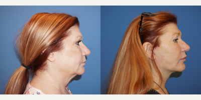 Neck Lift before and after photo