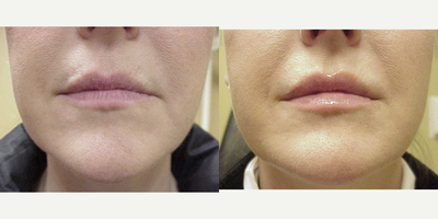 Restylane before and after photo