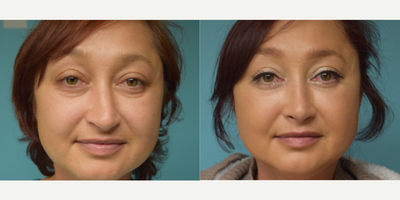 Rhinoplasty before and after photo