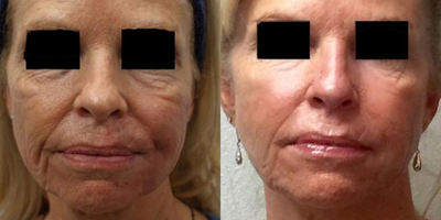 Dermal Fillers before and after photo