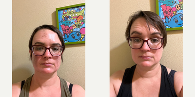 Jessner Peel before and after photo