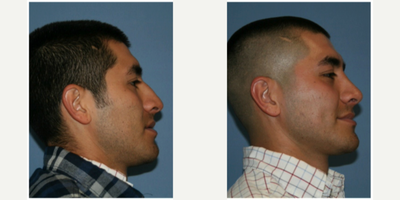 Rhinoplasty before and after photo