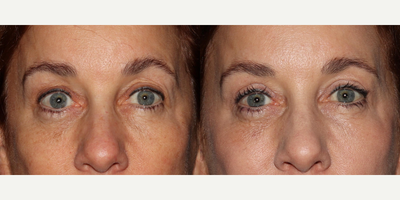 Eyelid Surgery before and after photo