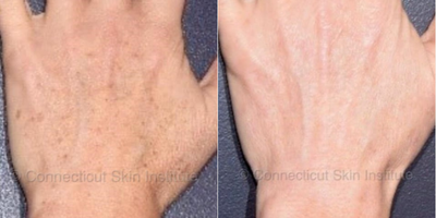 Fraxel Laser before and after photo