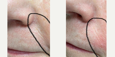 RHA Collection Fillers before and after photo