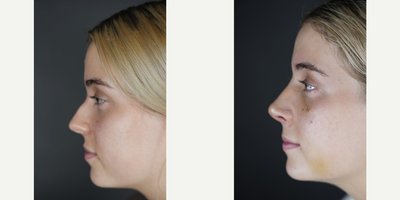Rhinoplasty before and after photo