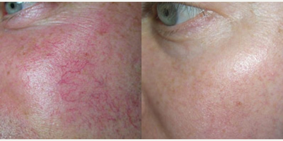 Sclerotherapy before and after photo