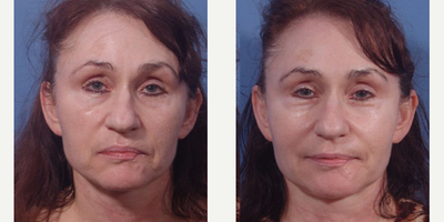 ArteFill before and after photo