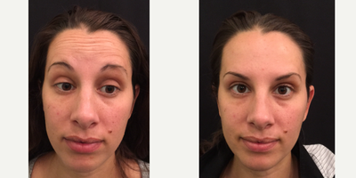 Dysport before and after photo