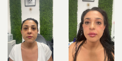 Jeuveau before and after photo
