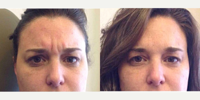 Botox before and after photo