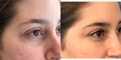 Dermal Fillers before and after photo