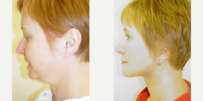 Facelift before and after photo