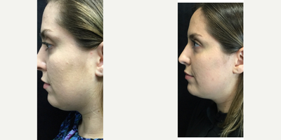 Kybella before and after photo
