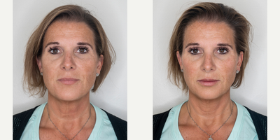 Lip Fillers before and after photo