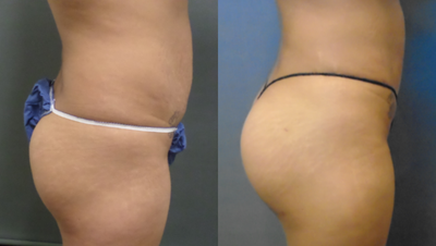 Brazilian Butt Lift before and after photo