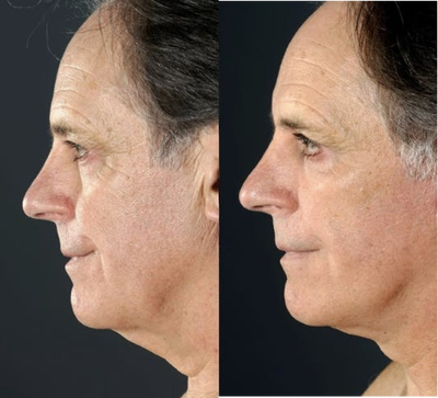 Facelift before and after photo