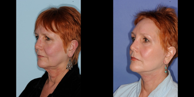 Neck Lift before and after photo