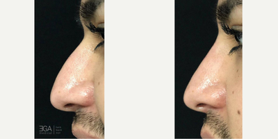 Nonsurgical Nose Job before and after photo