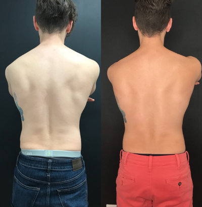 SculpSure before and after photo
