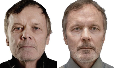 Dermal Fillers before and after photo