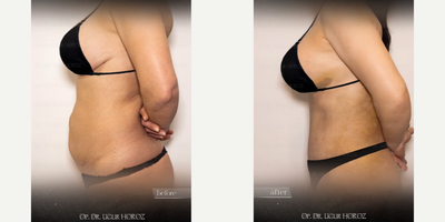 Liposuction before and after photo