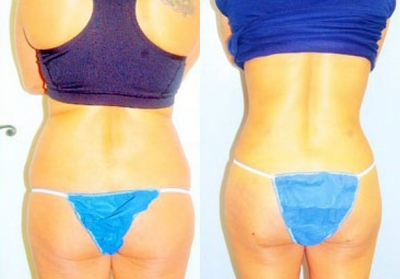 Smart Lipo before and after photo