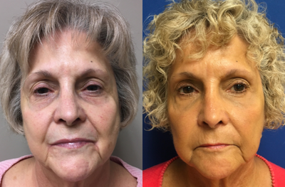 Bellafill before and after photo